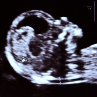 USG prenatalne  I trymestru ( 11-13+6 t.c.) z testem podwójnym w cenie